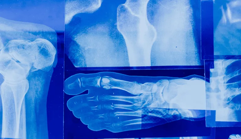 Un estudio con roedores revela cómo el ozono ayuda a fortalecer la masa ósea en pacientes con osteoporosis